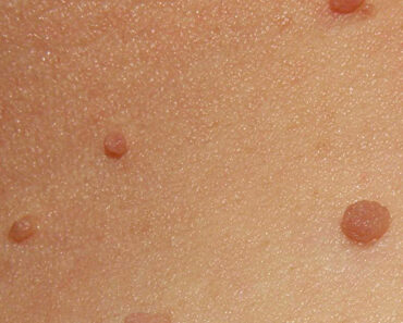 How to Remove Skin Tags: The Best Home Remedies!